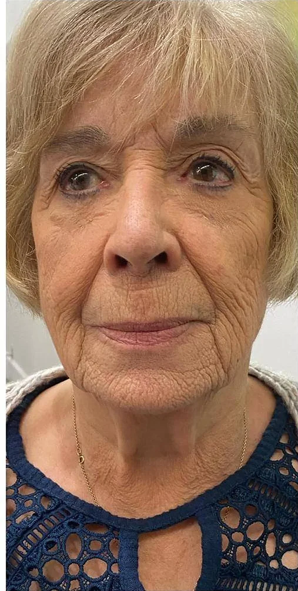 Before treatment