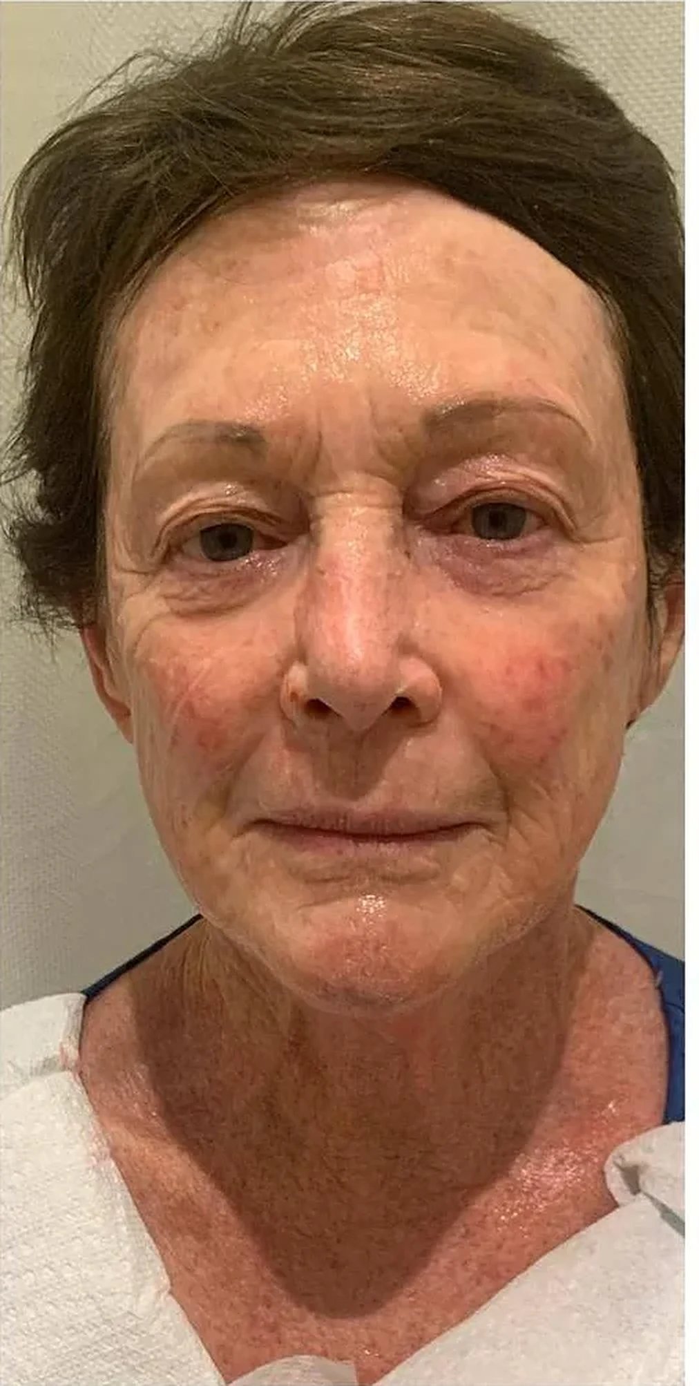 After — Tone & redness