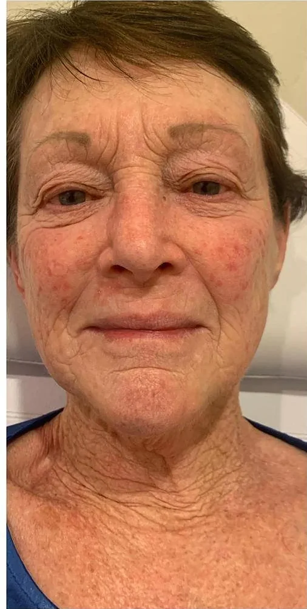 Before — Tone & redness